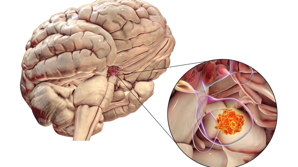 Acromegaly: Một căn bệnh hiếm gặp, khiến người lớn phát triển không kiểm soát được- Ảnh 3.