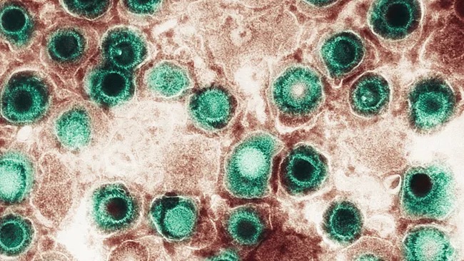 Virus herpes 'tái sinh' ẩn nấp trong não có thể liên quan đến chấn động và sa sút trí tuệ- Ảnh 1.